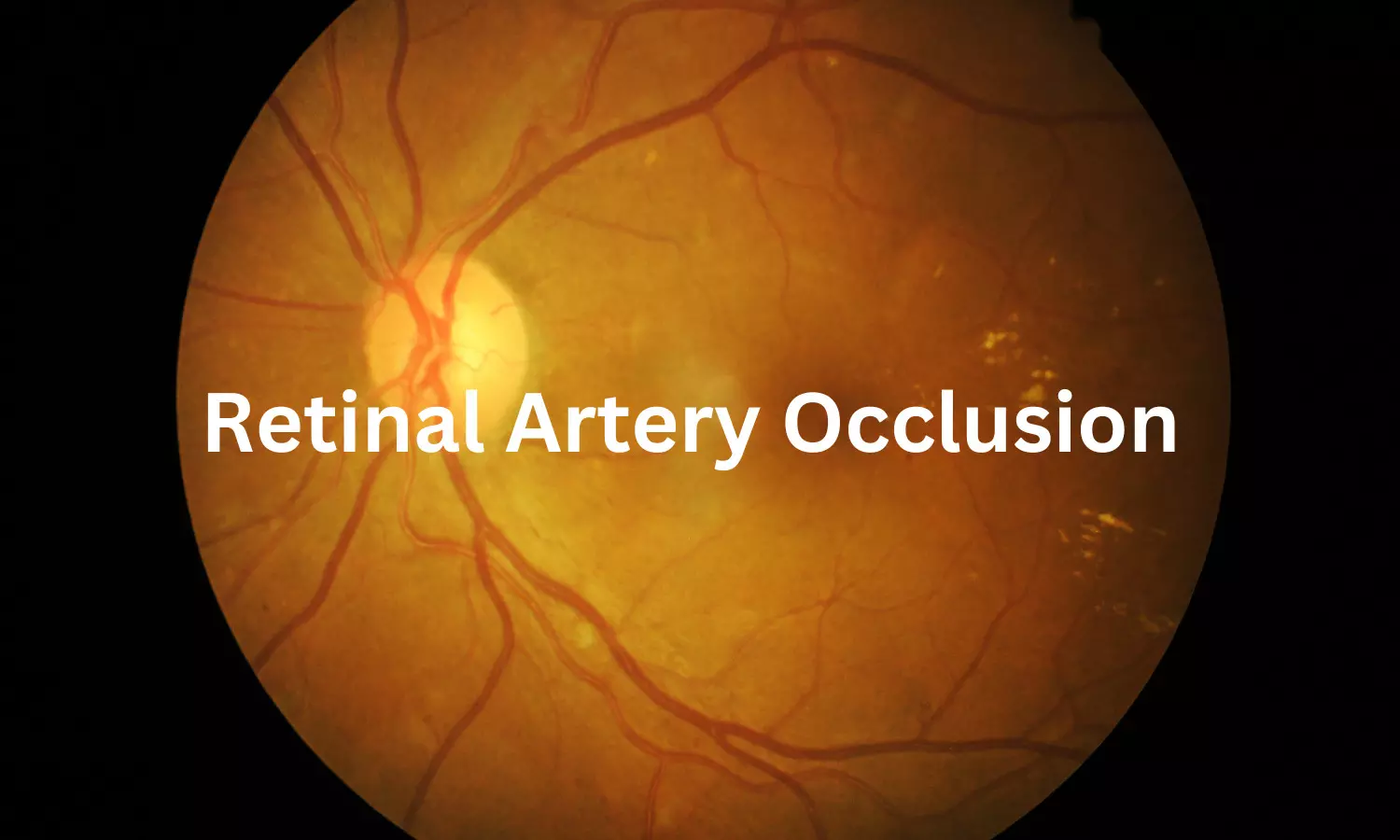 Retinal Artery Occlusion Significantly Increases Risk of Ischemic Stroke: Meta-Analysis Shows