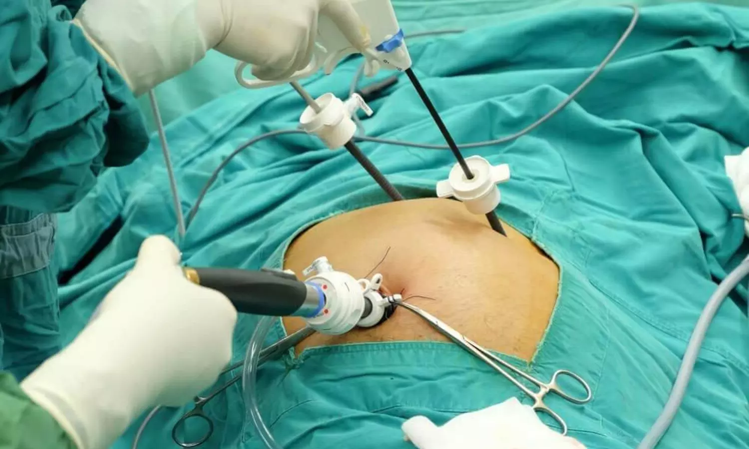 Single-Incision Laparoscopic Cholecystectomy Safe, Feasible, and Comparable to CLC: Study Shows