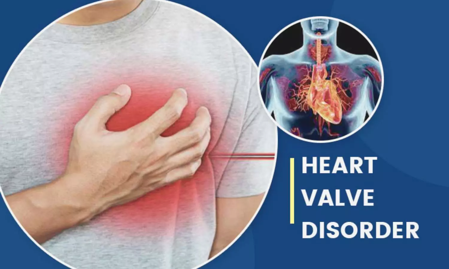2025 ESC/EACTS Valvular Heart Disease Guidelines Stress Heart Team, Advanced Imaging
