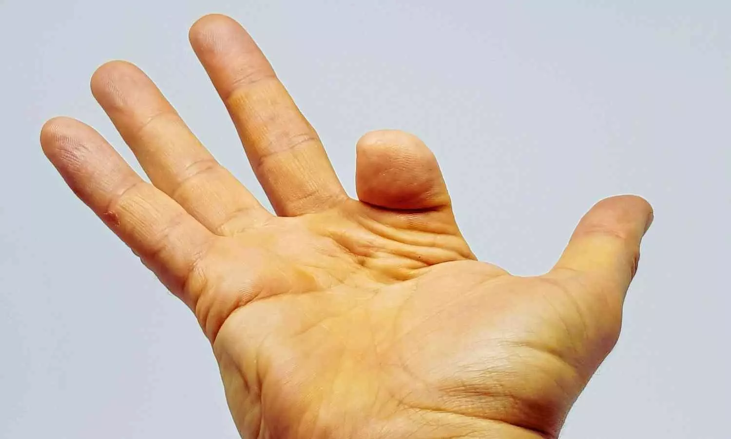 Toe transfer surgery may improve outcomes after finger amputation, reveals study