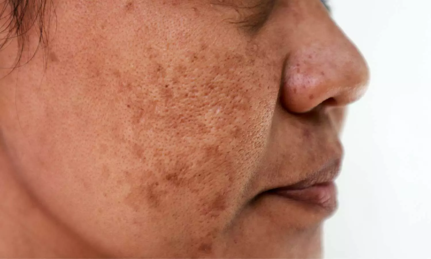 AOPT-LTL Therapy Improves Melasma via SCF/c-KIT Pathway Inhibition: Study Finds