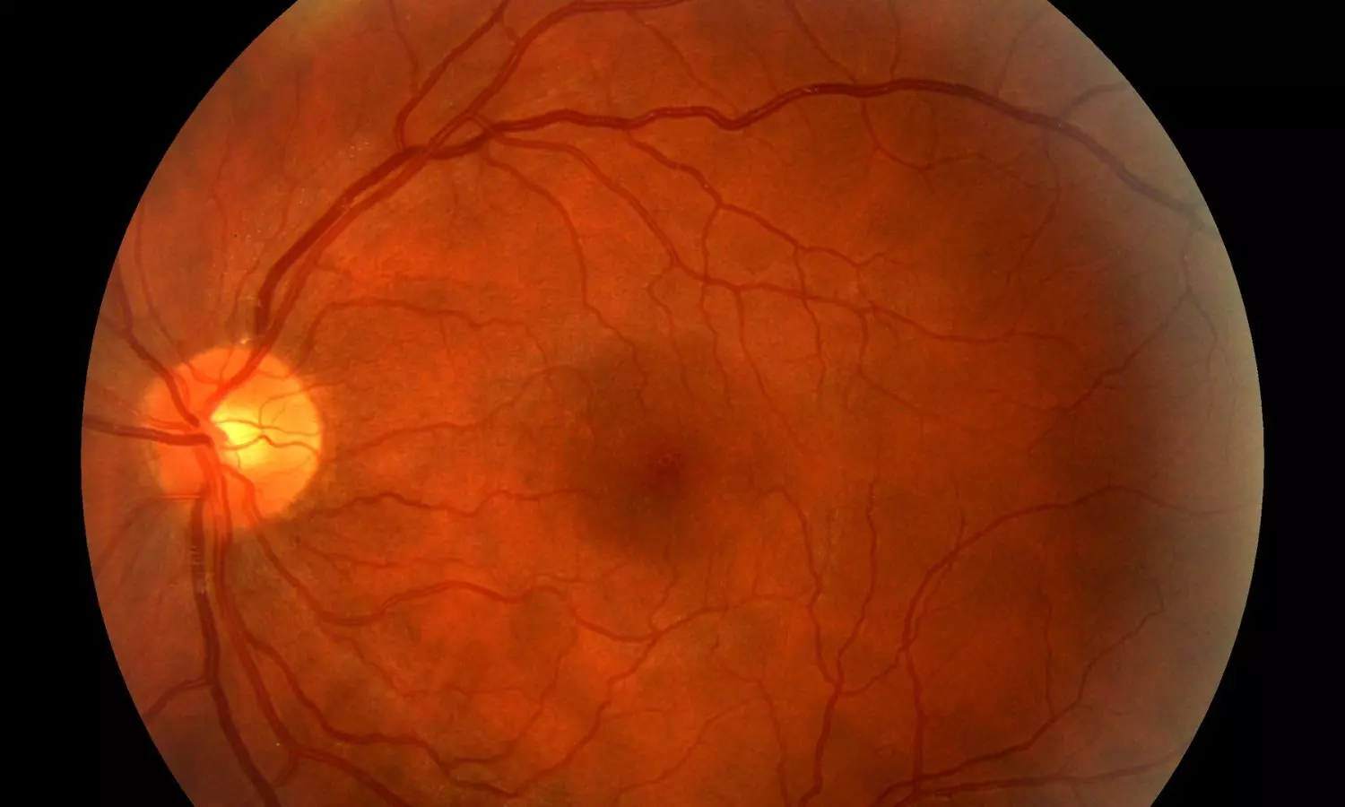 Strict Glucose Control Without Hypoglycemia Prevents Retinopathy: JAMA