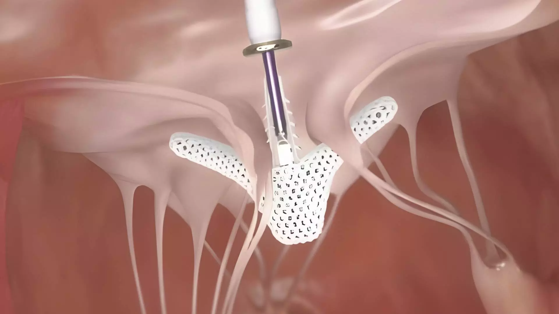TCT 2025: TRILUMINATE Pivotal Trial Confirms Safety, Efficacy and Quality-of-Life (QoL) Gains with TriClip Transcatheter Edge-to-Edge Repair (T- TEER) for Tricuspid Regurgitation (TR)