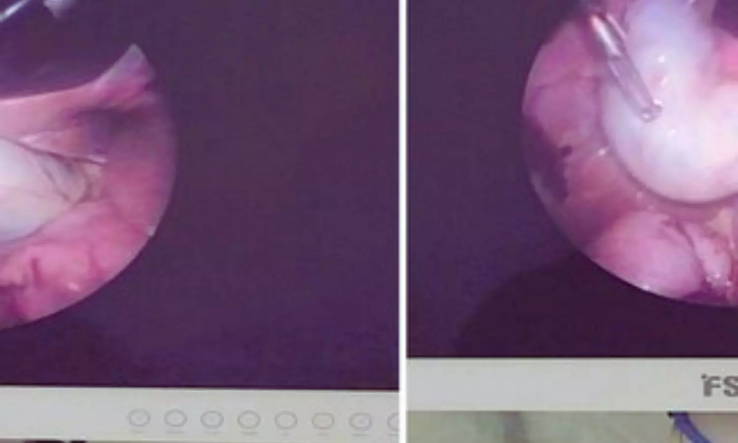 Rare Sigmoid Gallbladder Case Highlights Importance of Preoperative Imaging in Gallstone Surgery