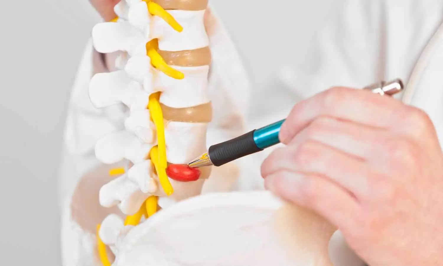 Unilateral biportal endoscopic decompression Proves Safe and Effective for Managing FLLDH: Study