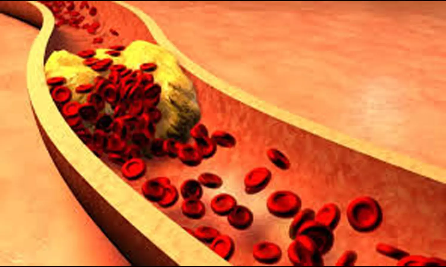 Elevated TyG Index Linked to Higher Risk of Developing Gout: Study