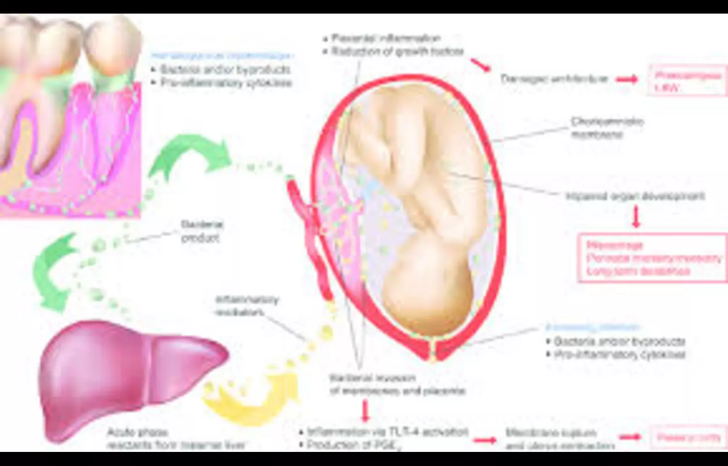 Poor Periodontal Health Linked to GDM in Pregnant Women: Study