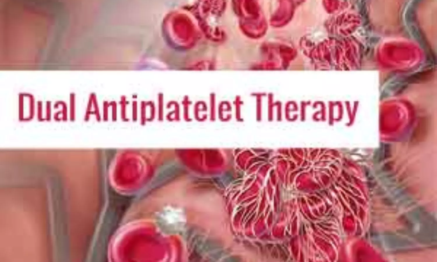 Antiplatelet therapy type Has Minimal Impact on Outcomes After Valve-in-Valve TAVR: Study