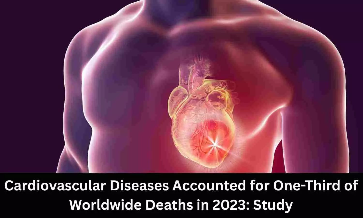 Cardiovascular Diseases Linked to One-Third of Deaths Worldwide in 2023: Study