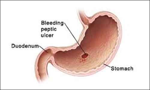 Peptic ulcer does not significantly increase CVD risk, finds study