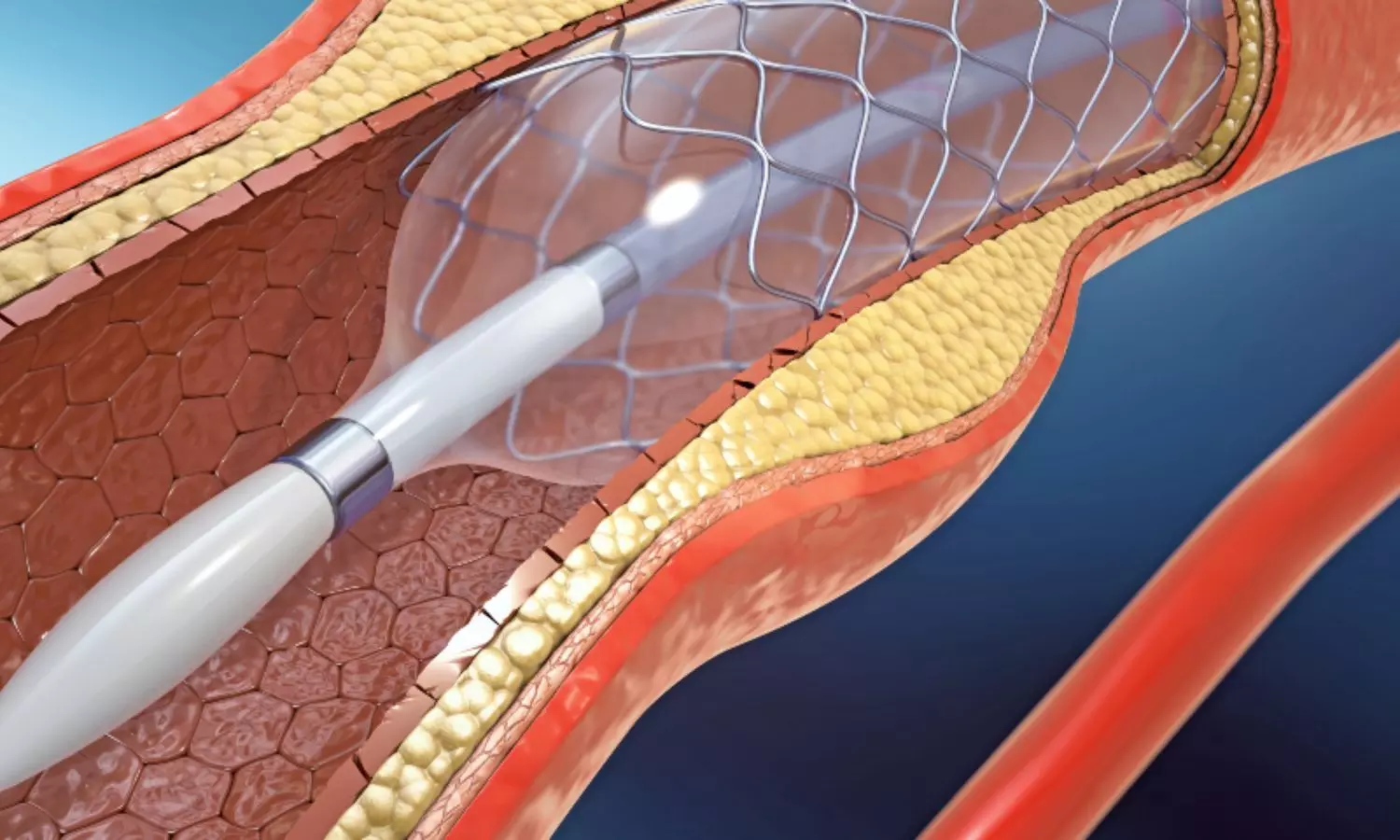 Hemodialysis Patients Face Higher Restenosis Risk After DCB Therapy, But Limb Salvage Remains High: POPCORN Registry
