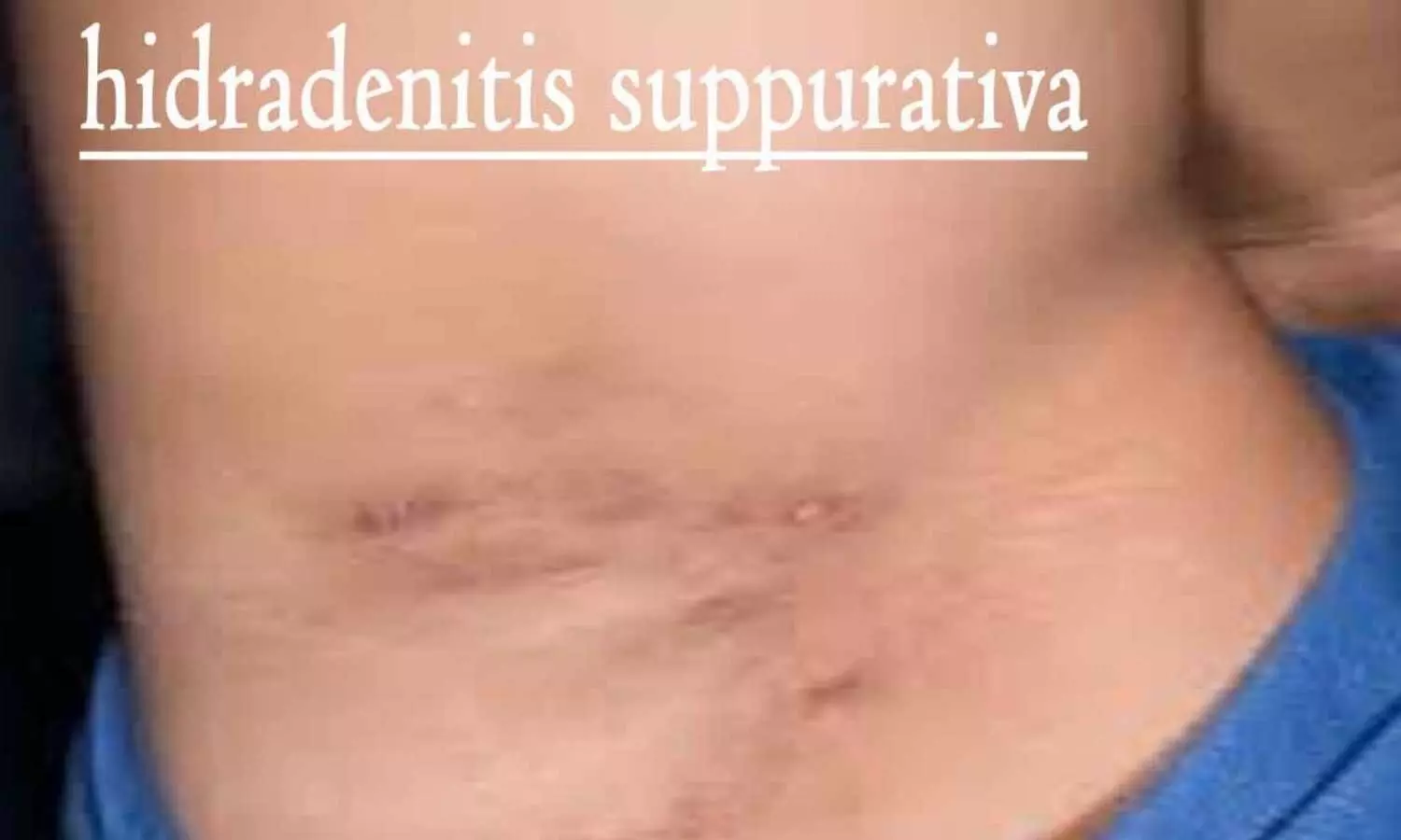 Hidradenitis Suppurativa Linked to Higher Risk of Peripheral Arterial Disease, Study Finds