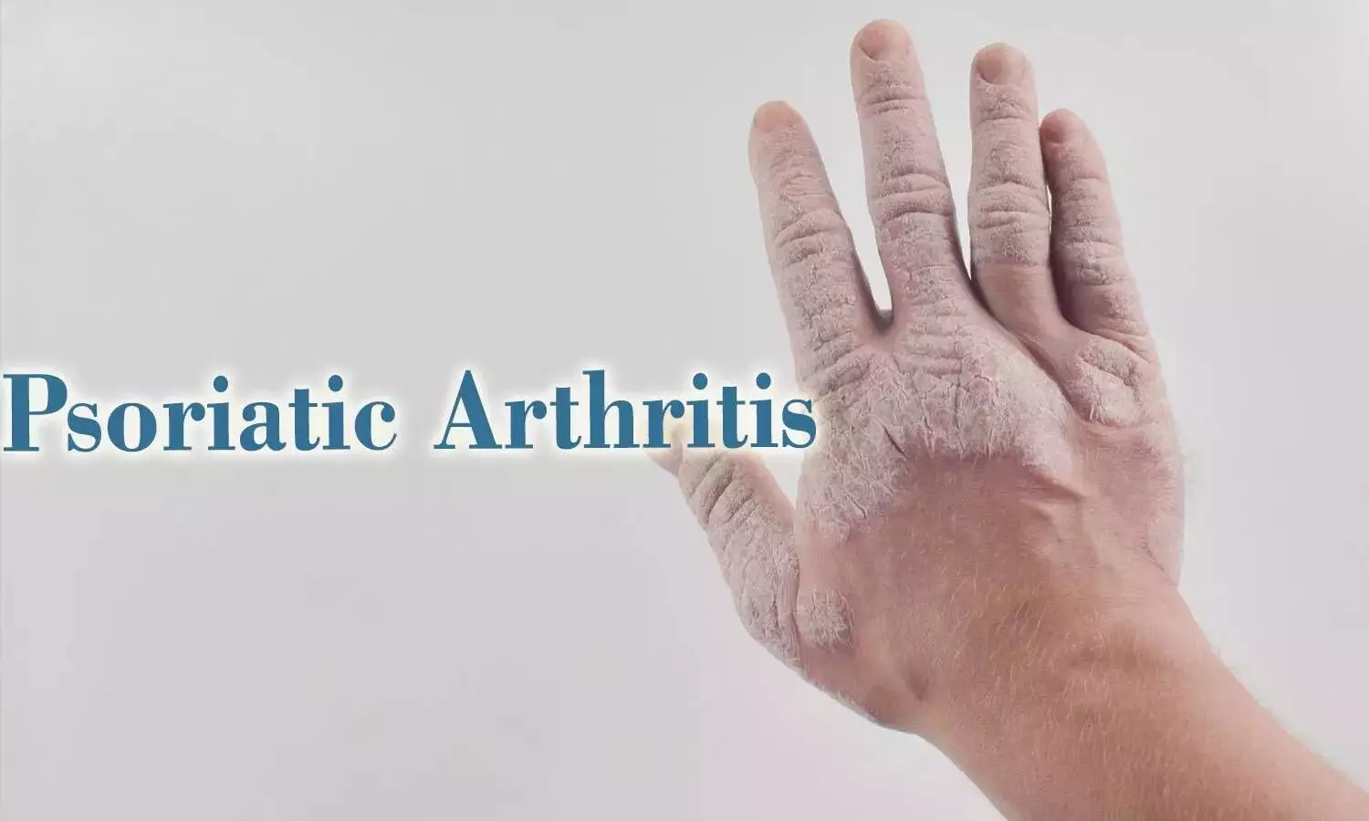 Psoriatic Arthritis Patients Face Higher Burden of Metabolic Syndrome, Meta-Analysis Shows