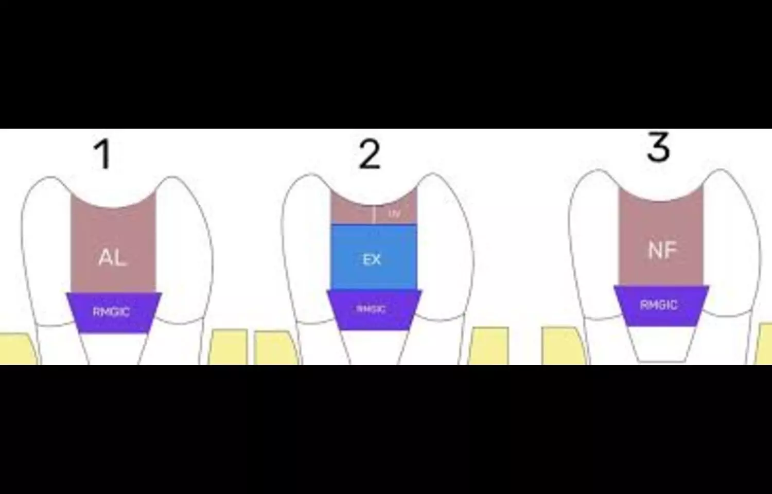 SFRCs Show Superior Fracture Resistance and Clinical Potential to conventional resin composites: Study
