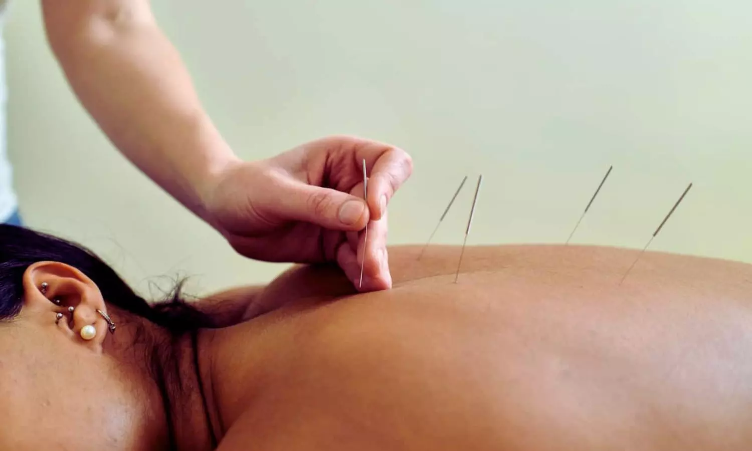 Acupuncture may Improve Glycemic Control in Type 2 Diabetes: Study