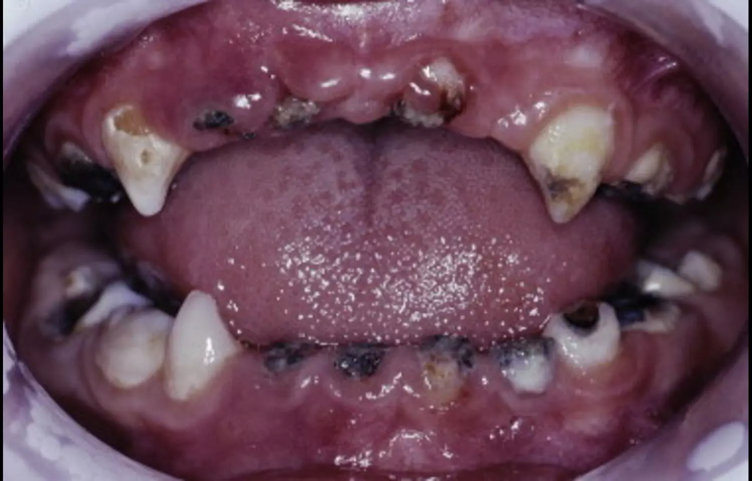 Dental Caries and BMI have bidirectional association among Deprived Adolescents, suggests study
