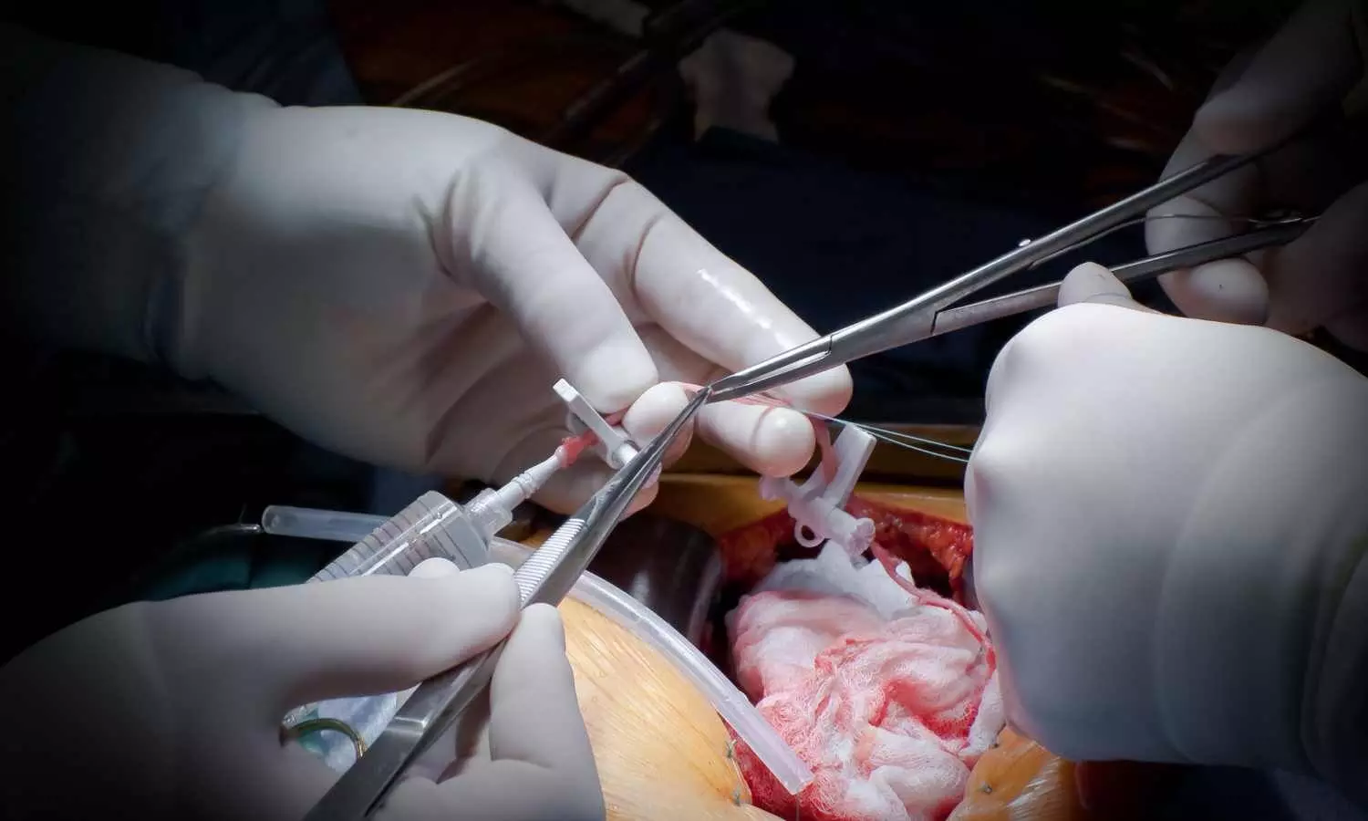 Coronary Microvascular Dysfunction Increases Risk of Heart Events in Diabetic Patients: Study