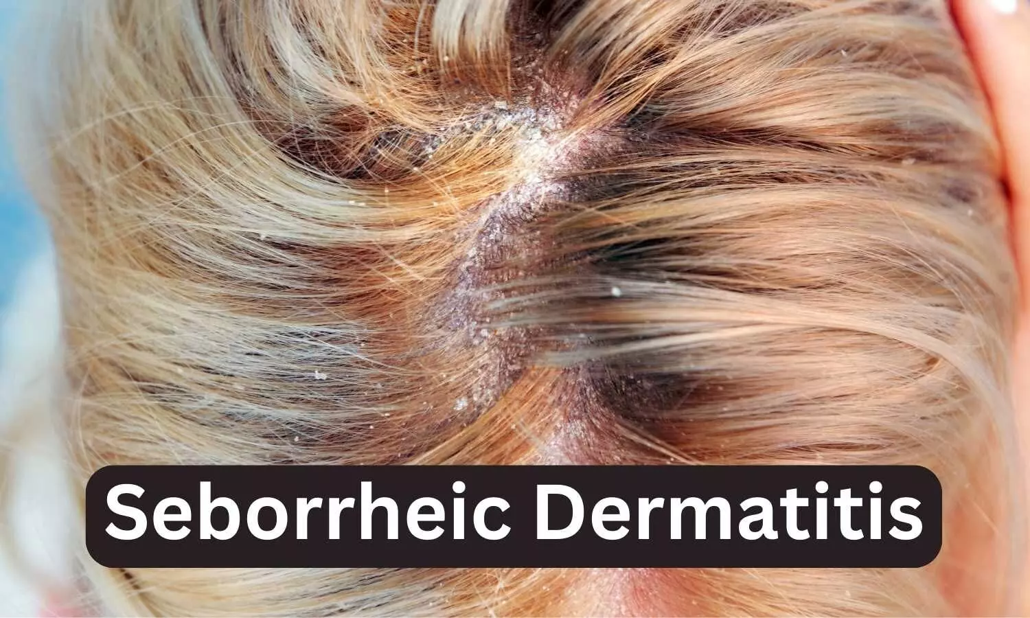 Study Reveals Two-Way Link Between Seborrheic Dermatitis and Other Barrier Diseases
