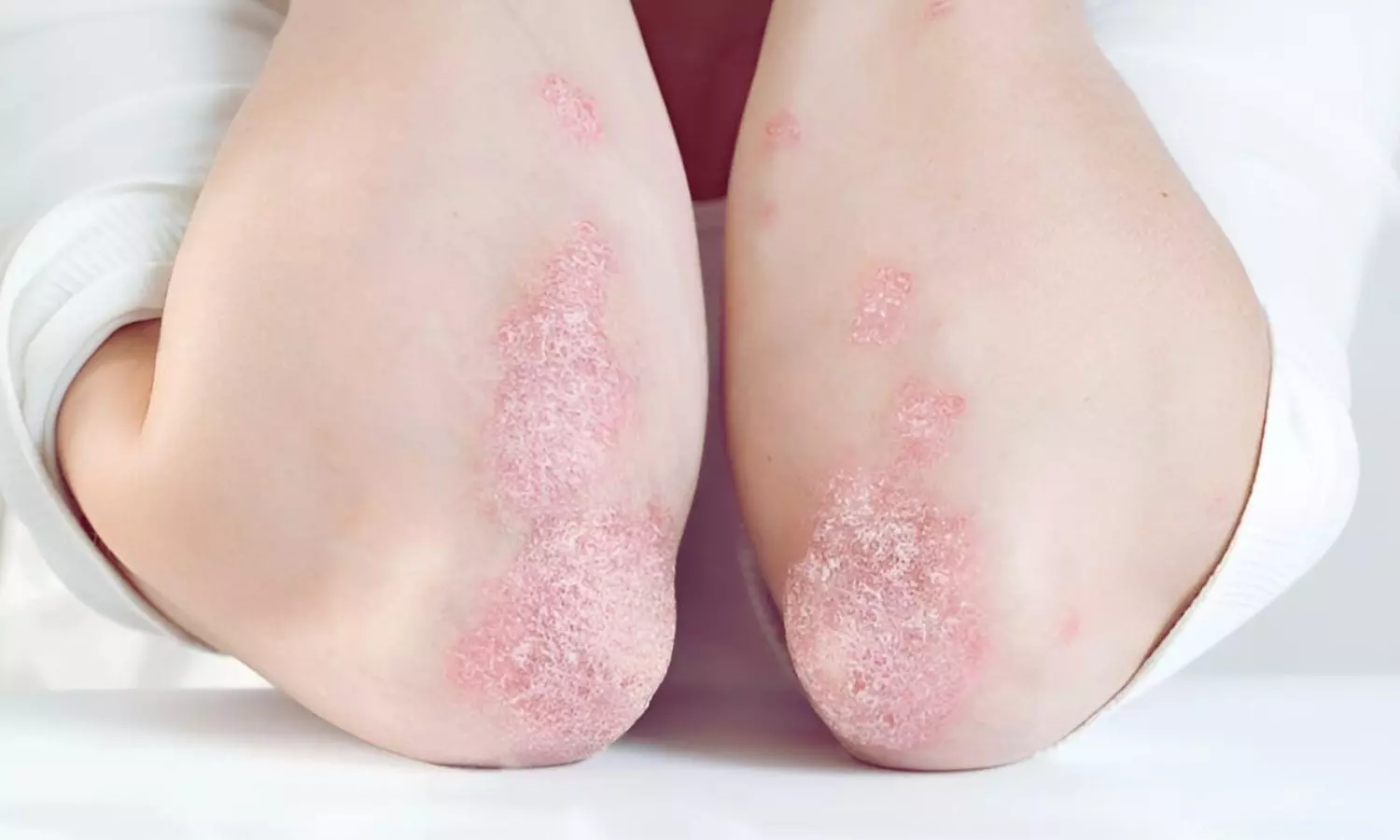 Psoriasis Doubles Risk of Diabetic Retinopathy in Type 2 Diabetes Patients: Study Finds