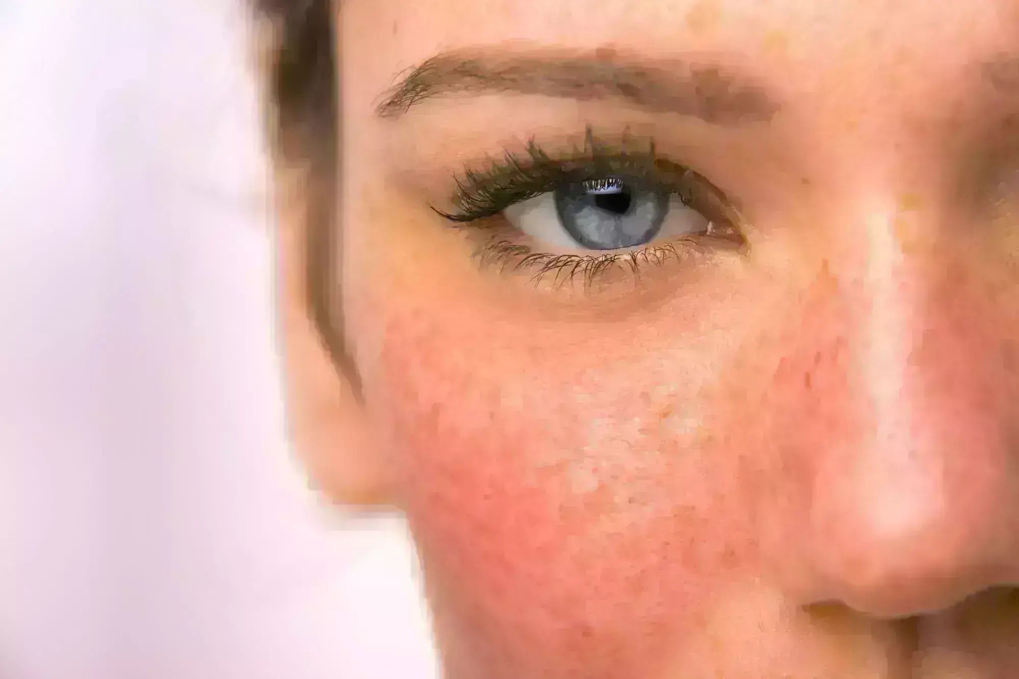 taVNS Shows Promise as New Treatment for erythematotelangiectatic rosacea: JAMA