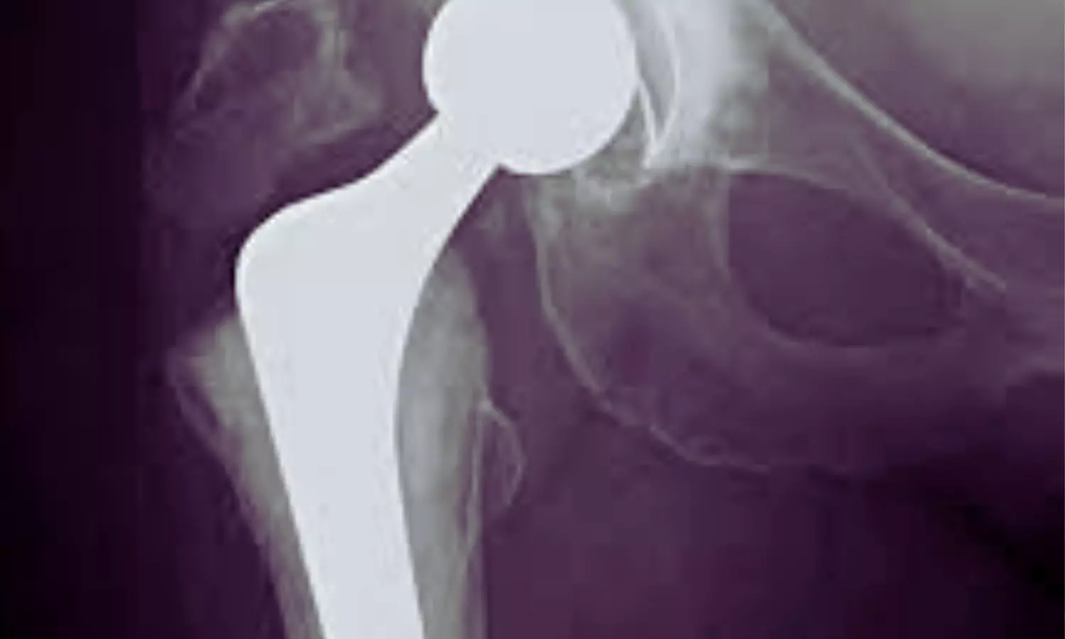 Starting Osteoporosis Medication After Hip Fracture Halves Risk of Implant-Related Breaks: Study Suggests